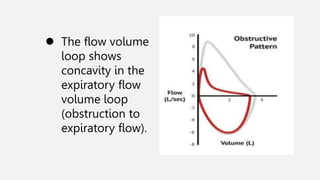  The flow volume
loop shows
concavity in the
expiratory flow
volume loop
(obstruction to
expiratory flow).
 