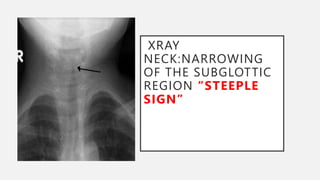 XRAY
NECK:NARROWING
OF THE SUBGLOTTIC
REGION “STEEPLE
SIGN”
 