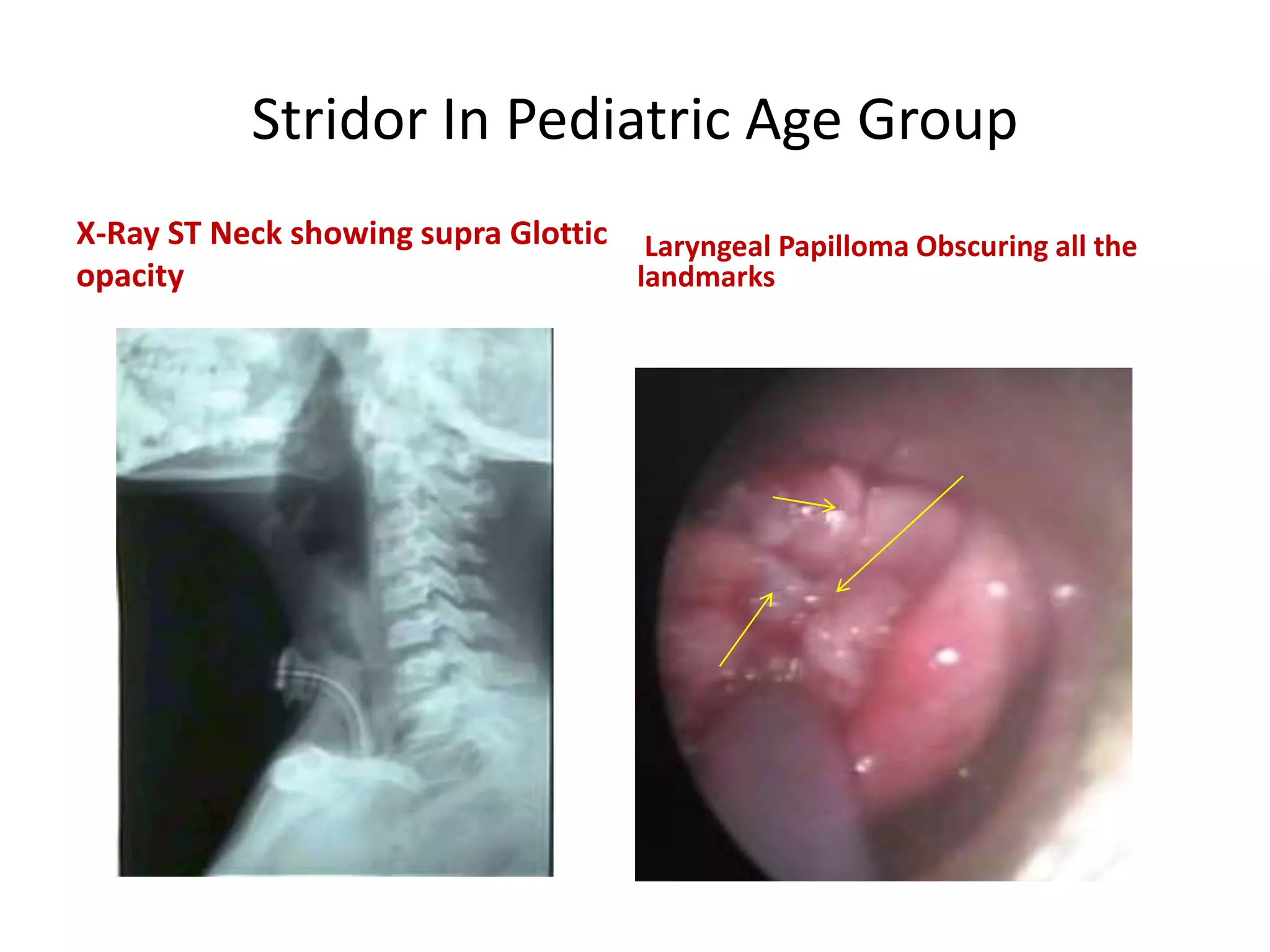 Stridor Scope Stridor in pediatric age group | PPTX