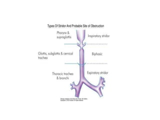 Stridor Pattern An approach to a case of Paediatric Stridor | PPTX