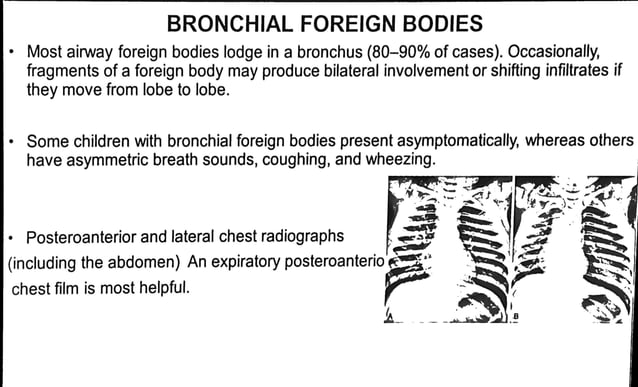 Approach to Stridor in Children - Pediatrics | PDF | Ear, Nose and ...