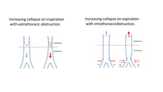 Increasing collapse on inspiration
with extrathoracic obstruction.
Increasing collapse on expiration
with intrathoracicobstruction.
 