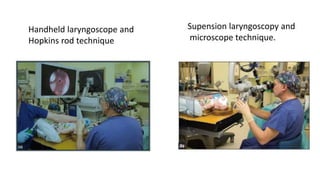 Handheld laryngoscope and
Hopkins rod technique
Supension laryngoscopy and
microscope technique.
 
