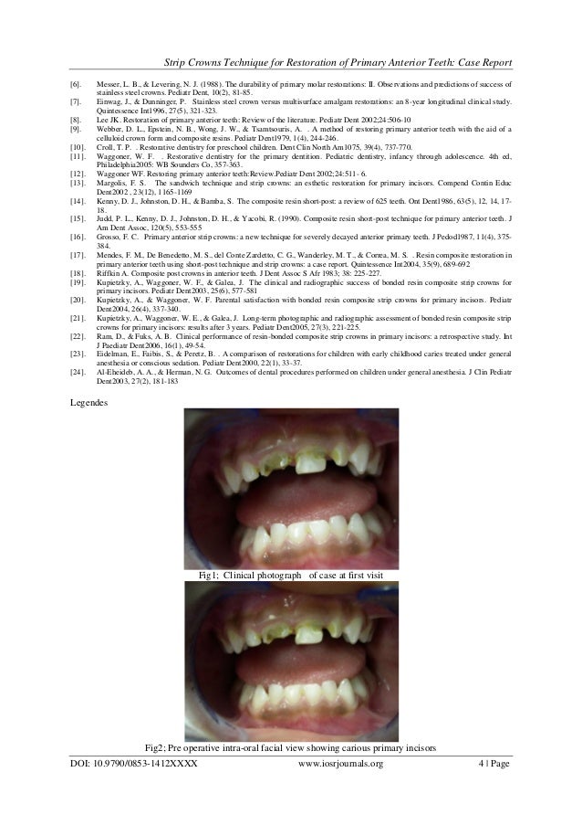 Strip Crowns Technique for Restoration of Primary Anterior Teeth Cas…