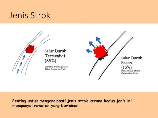 Penyakit Strok