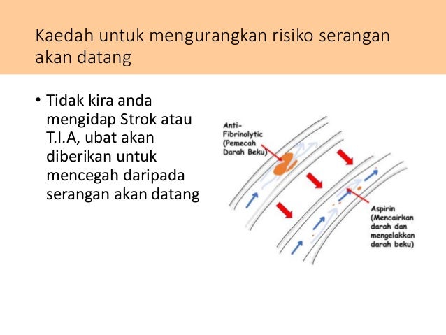 Penyakit Strok