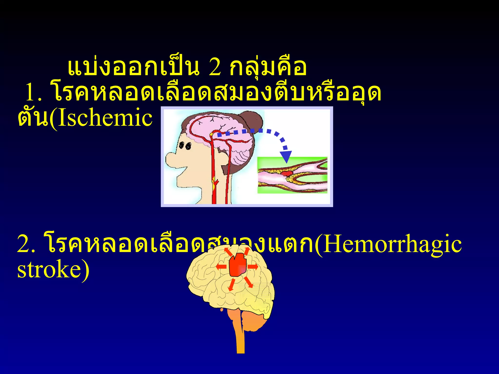 Stroke | PPT