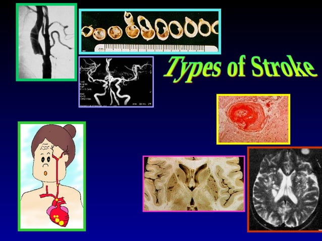 Stroke | PPT