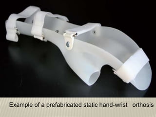 .
Example of a prefabricated static hand-wrist orthosis
 