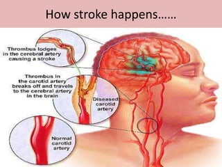 How stroke happens……
 