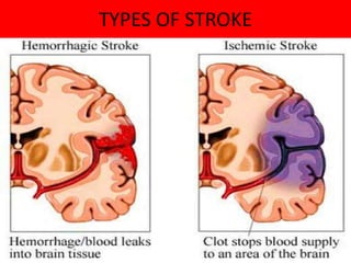 TYPES OF STROKE
 