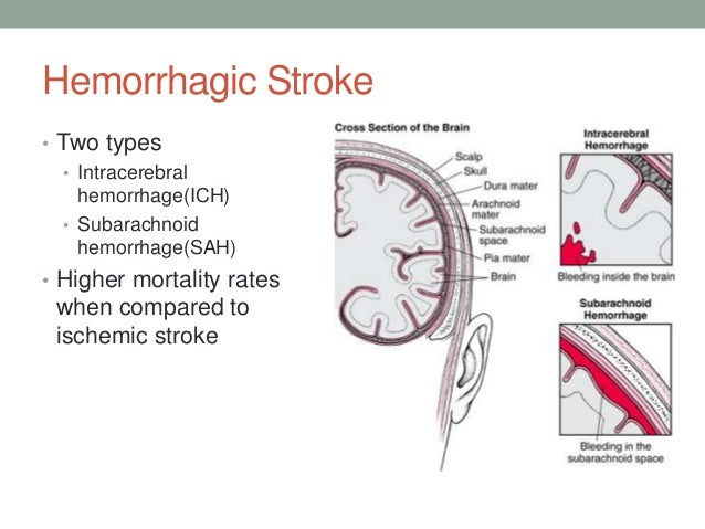 Ischemic and hemorrhagic stroke