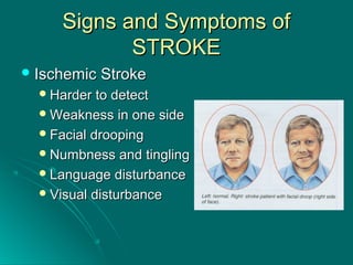 Signs and Symptoms ofSigns and Symptoms of
STROKESTROKE
 Ischemic StrokeIschemic Stroke
Harder to detectHarder to detect
Weakness in one sideWeakness in one side
Facial droopingFacial drooping
Numbness and tinglingNumbness and tingling
Language disturbanceLanguage disturbance
Visual disturbanceVisual disturbance
 