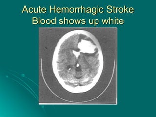 Acute Hemorrhagic StrokeAcute Hemorrhagic Stroke
Blood shows up whiteBlood shows up white
 
