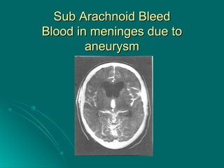 Sub Arachnoid BleedSub Arachnoid Bleed
Blood in meninges due toBlood in meninges due to
aneurysmaneurysm
 