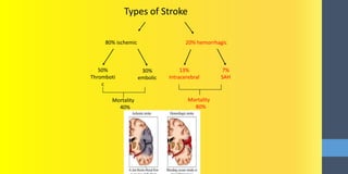 Types of Stroke
80% ischemic 20% hemorrhagic
50%
Thromboti
c
30%
embolic
13%
Intracerebral
7%
SAH
Mortality
40%
Mortality
80%
 