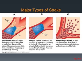 Major Types of Stroke
Fig. 56-3
 