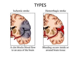 Stroke and its management | PPT