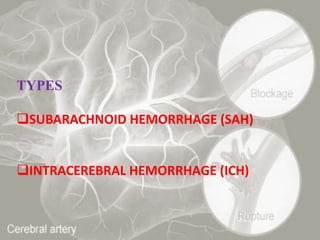 Sah Types Stroke | PPTX