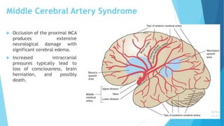 Middle Cerebral Artery Syndrome
 Occlusion of the proximal MCA
produces extensive
neurological damage with
significant cerebral edema.
 Increased intracranial
pressures typically lead to
loss of consciousness, brain
herniation, and possibly
death.
 
