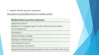  Medial inferior pontine syndrome
Occlusion of paramedian branch of basilar artery
 