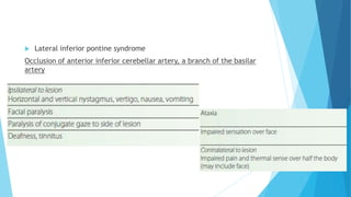  Lateral inferior pontine syndrome
Occlusion of anterior inferior cerebellar artery, a branch of the basilar
artery
 
