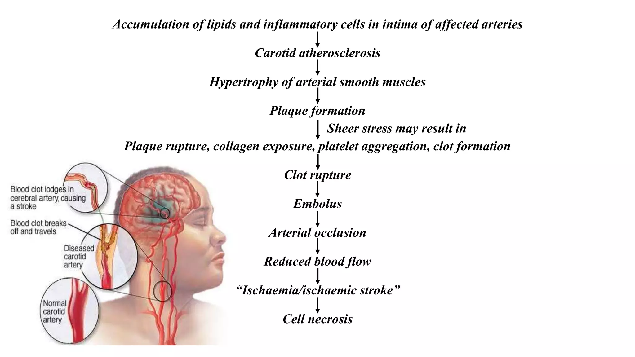 Classification, Pathophysiology and management of Brain Stroke for ...