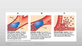 30/06/2020 STROKE (Dr Akshay Shetty) 10
 