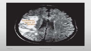 30/06/2020 STROKE (Dr Akshay Shetty) 12
 