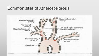 Common sites of Atheroscelorosis
30/06/2020 STROKE (Dr Akshay Shetty) 13
 