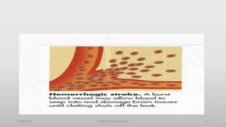 30/06/2020 STROKE (Dr Akshay Shetty) 15
 