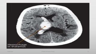 30/06/2020 STROKE (Dr Akshay Shetty) 16
 