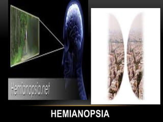 HEMIANOPSIA
 