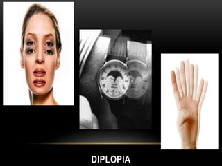 DIPLOPIA
 