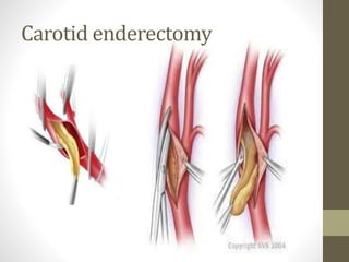 Carotid enderectomy
 