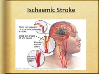 Ischaemic Stroke
 