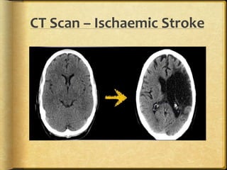 CT Scan – Ischaemic Stroke
 