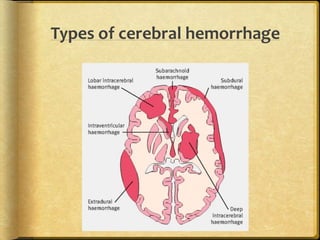 Types of cerebral hemorrhage
 