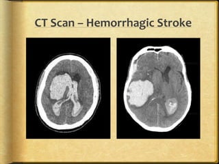 CT Scan – Hemorrhagic Stroke
 