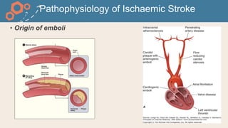 Pathophysiology of Ischaemic Stroke
• Origin of emboli
 