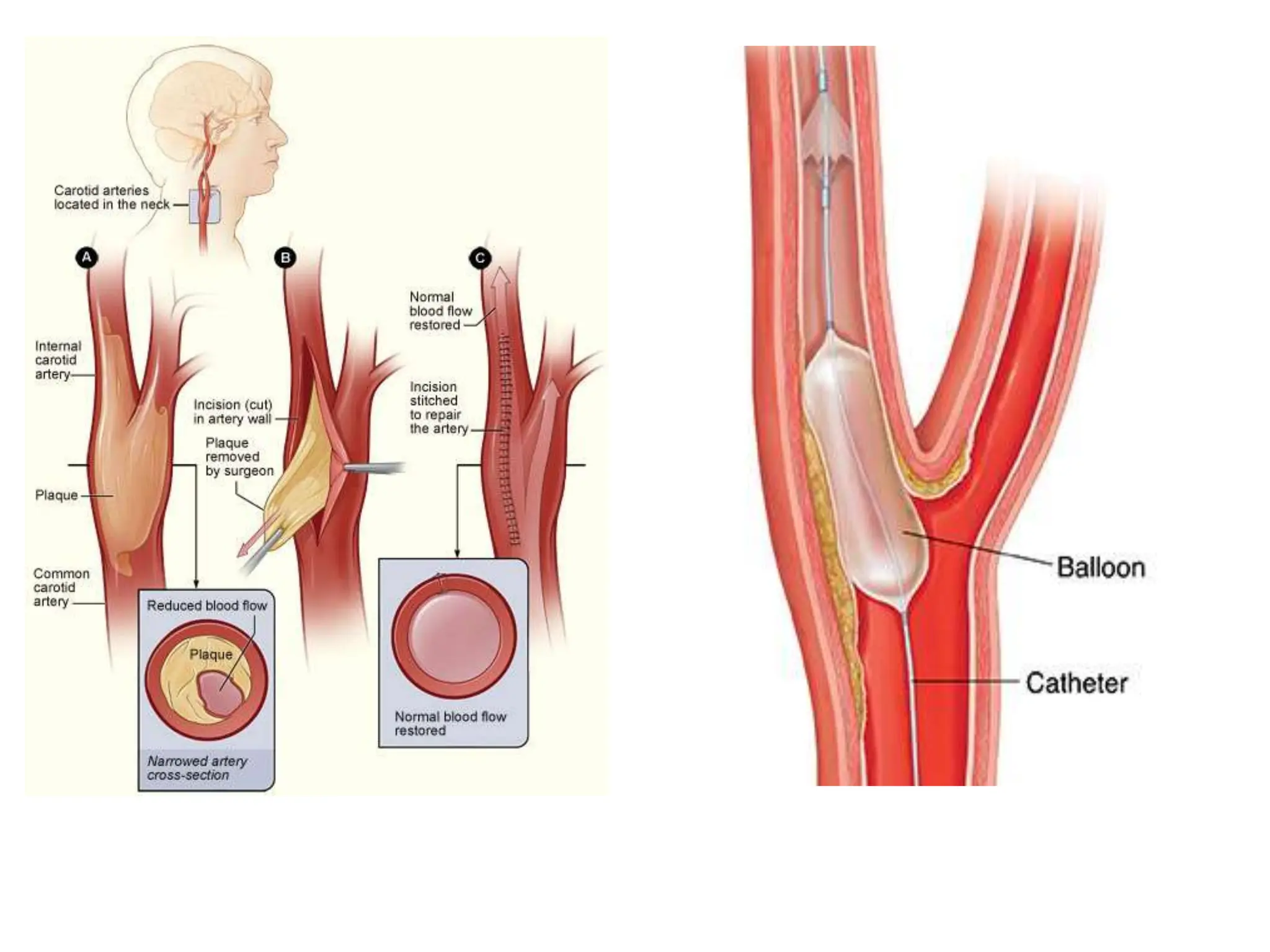 Management of Cerebro vascular accident (CVA) | PPT