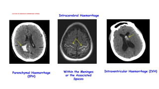 LOCATION OF BLEEDING IN HEMORRHAGIC STROKES
Intracerebral Haemorrhage
Within the Meninges
or the Associated
Spaces
Intraventricular Haemorrhage (IVH)
Parenchymal Haemorrhage
(IPH)
 