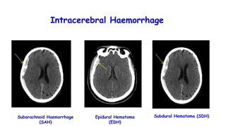 Subarachnoid Haemorrhage
(SAH)
Epidural Hematoma
(EDH)
Subdural Hematoma (SDH)
Intracerebral Haemorrhage
 