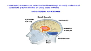 • Parenchymal, intraventricular, and subarachnoid haemorrhages are usually stroke-related.
Subdural and epidural hematomas are usually caused by trauma.
INTRACEREBERAL HAEMORRHAGE
 