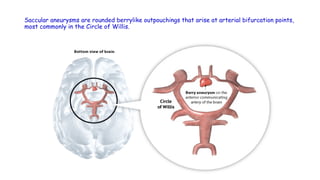 Saccular aneurysms are rounded berrylike outpouchings that arise at arterial bifurcation points,
most commonly in the Circle of Willis.
 