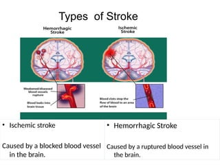 Types of Stroke
• Ischemic stroke
Caused by a blocked blood vessel
in the brain.
• Hemorrhagic Stroke
Caused by a ruptured blood vessel in
the brain.
 