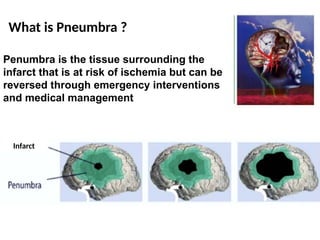 Penumbra is the tissue surrounding the
infarct that is at risk of ischemia but can be
reversed through emergency interventions
and medical management
What is Pneumbra ?
Infarct
 