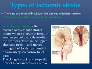 Brain stroke: Symptoms, Classification, prevention and management .pptx