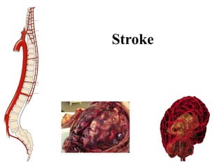 STROKE - Neurology Department - Internal Medicine | PPTX