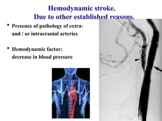 STROKE - Neurology Department - Internal Medicine | PPTX